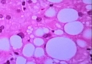 fatty liver cells